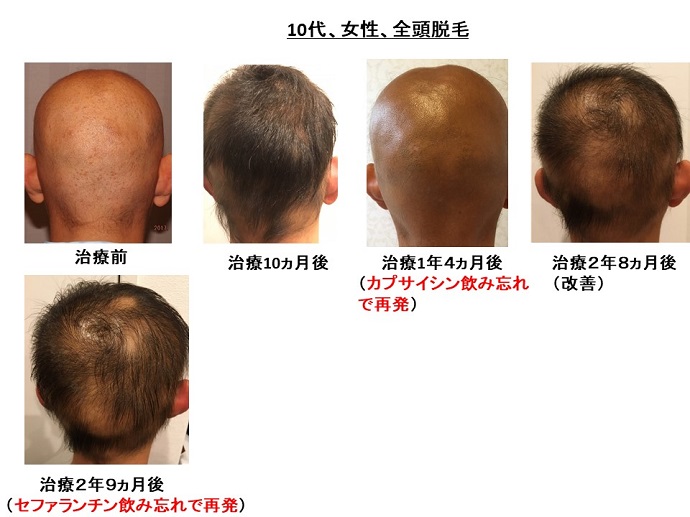 円形脱毛症　病院